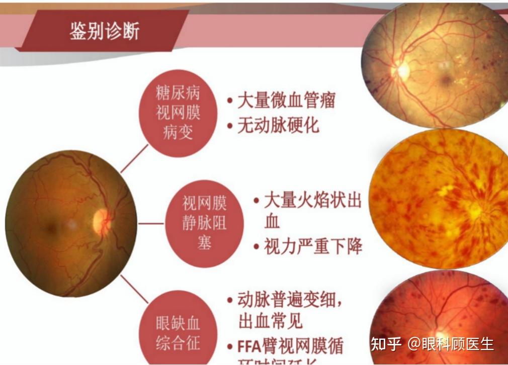 什么是高血压性视网膜病变?