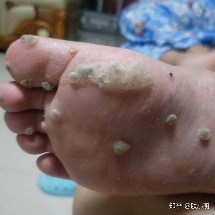 跖疣为什么会复发
