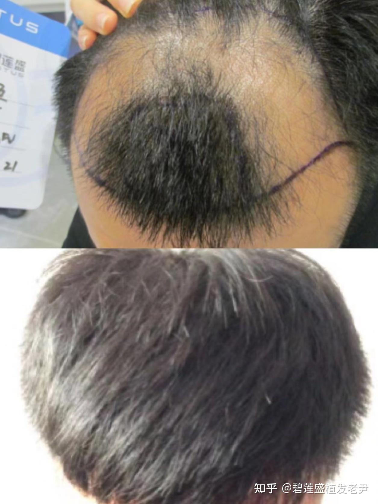 遗传性脱发是怎么回事能治好吗