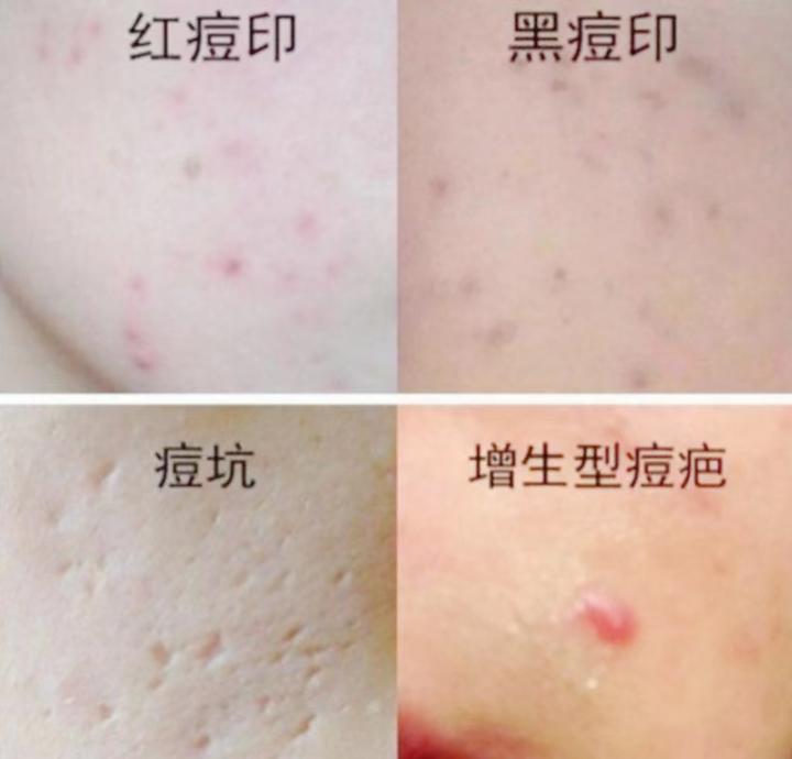关于痘印你了解多少?你是属于哪一种痘印?#祛痘推荐#痘痘、痘印女孩# - 知乎