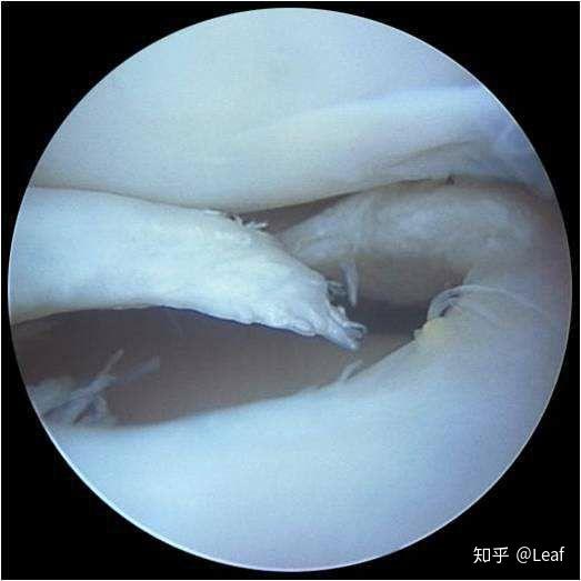 漫長的一週盤狀半月板撕裂手術紀實