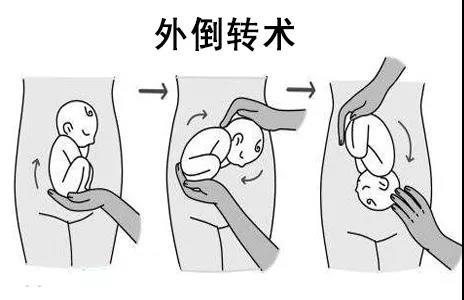 外倒转术(37周左右)医生会向孕妇腹壁施加压力,用手向前或向后旋转