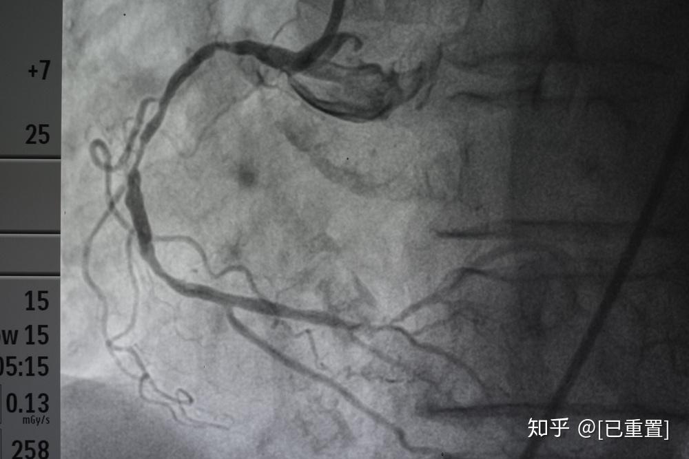 心脏造影多少钱对身体有哪些危害医生一次性说清收获不少