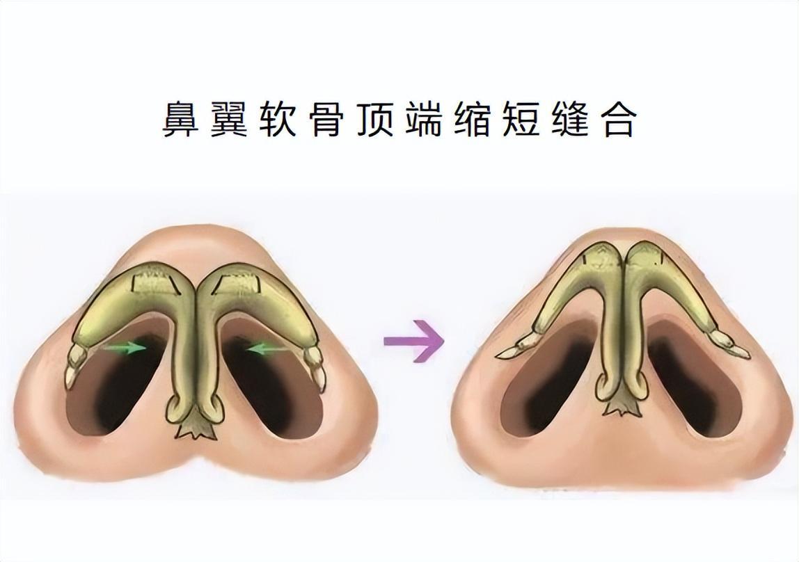 第十七节 经鼻-蝶窦径路垂体腺瘤切除术-眼耳鼻喉-医学