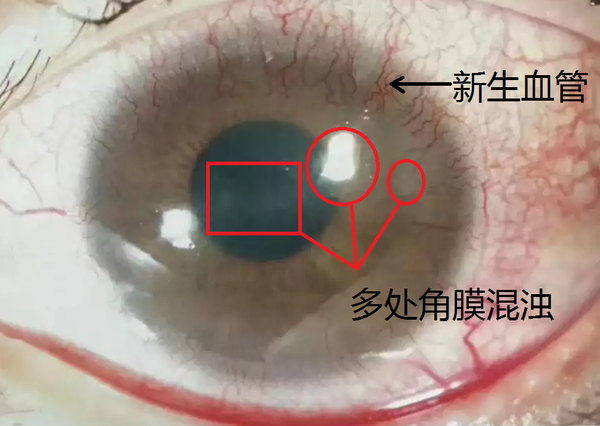 角膜浑浊为角膜透明区出现白色雾状区,图中照明反光对中央大圈处雾状