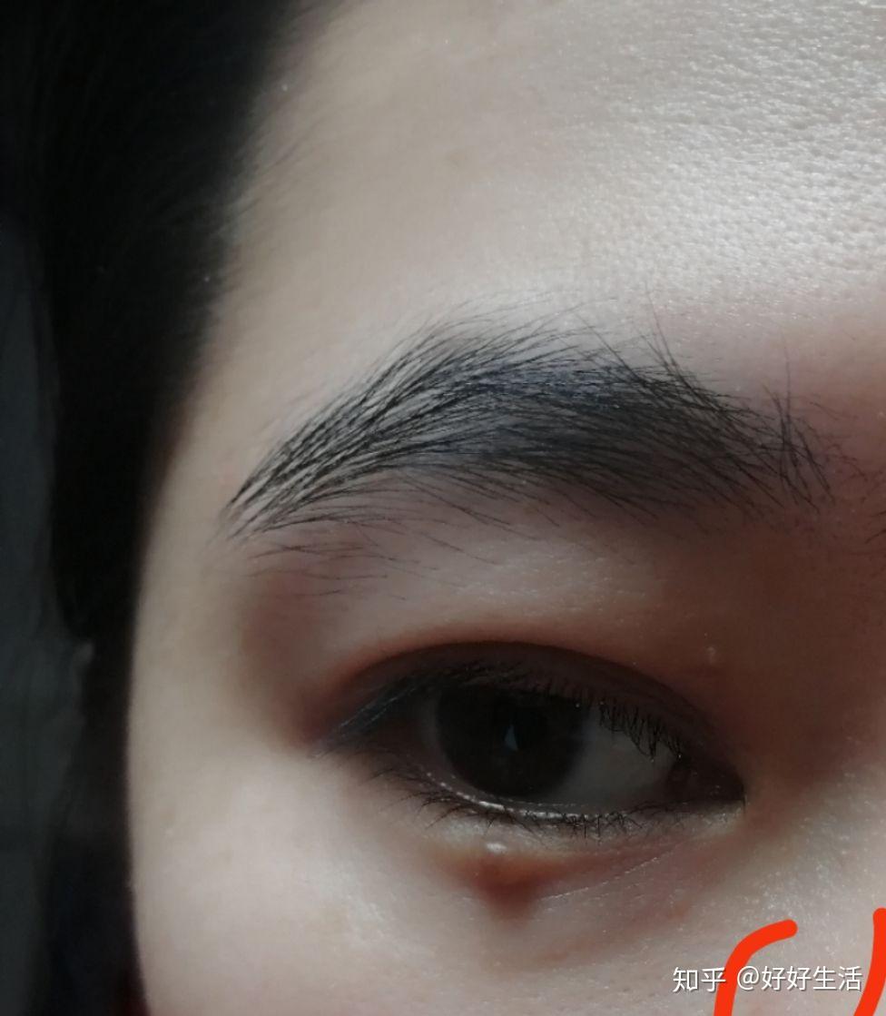 手术去痣眼睑痣