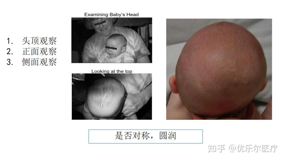 头颅畸形—舟状头 - 知乎