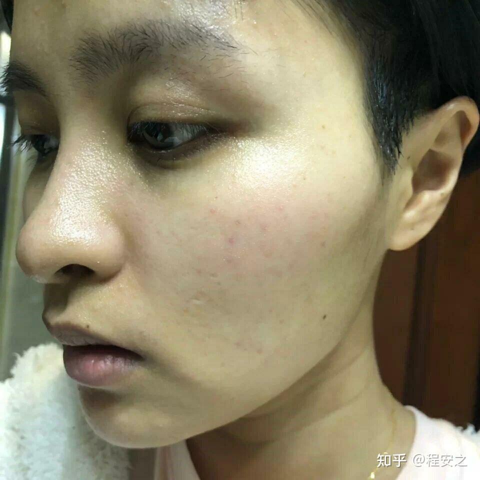 怎么才能使自己过敏 v2-849eff978487c1c8cf8d73ff42cb223a_r.jpg