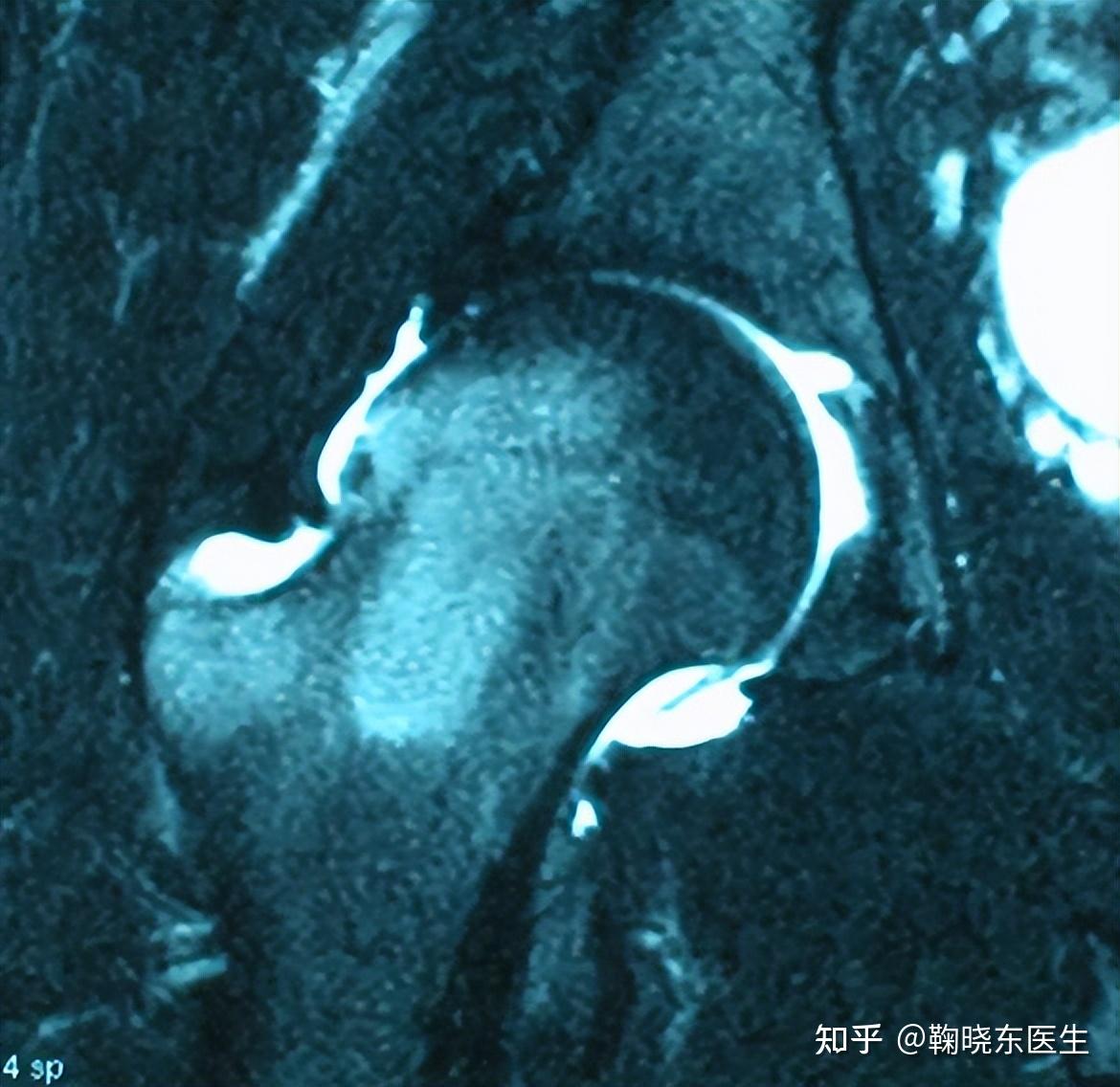 髋关节撞击综合征盂唇撕裂怎么办如何治疗