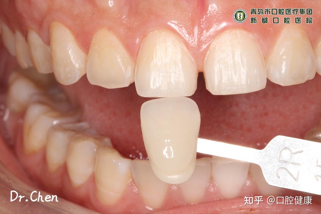 病例展示超薄瓷貼面關閉上前牙縫隙