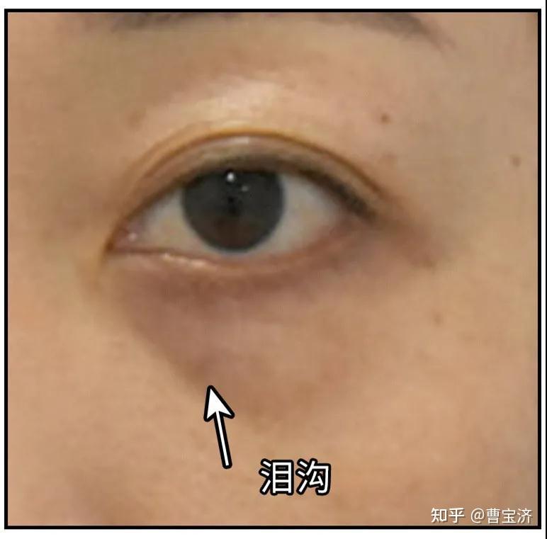 看似一条小沟,呈八字型位于鼻侧.