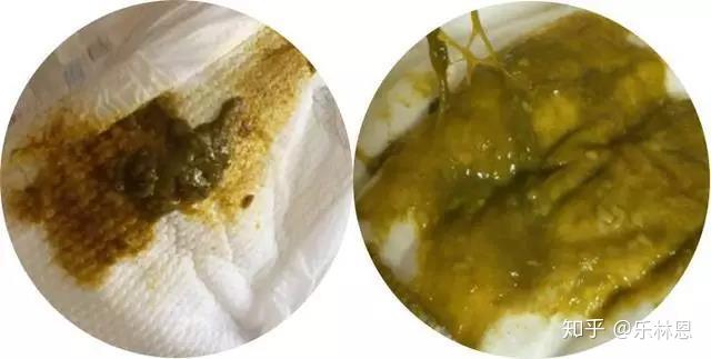 大便酸性时,内含胆汁遇空气氧化成绿色.