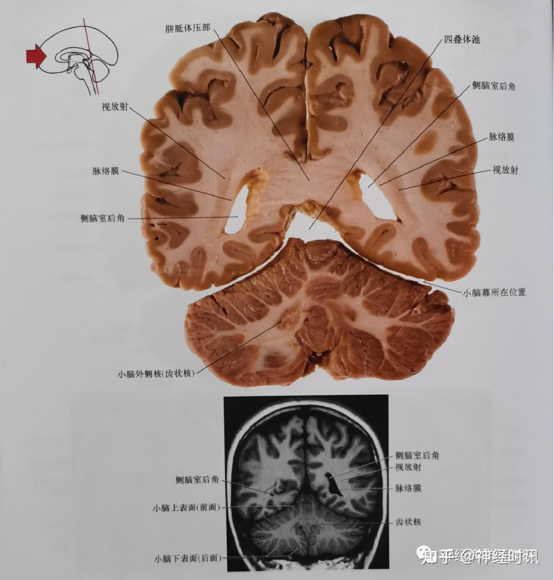 臨床神經解剖圖譜(斷層影像 切片) - 知乎