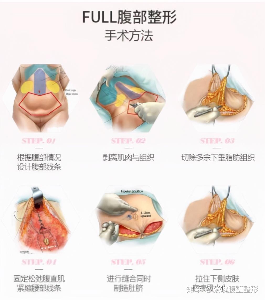 科普文章男性也能做腹壁成形術