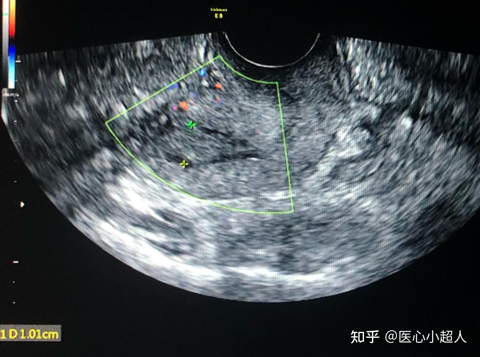 子宫内膜癌彩超图片