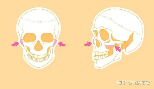九院韦敏说,颧弓颧骨整形为什么不能过度? - 知乎