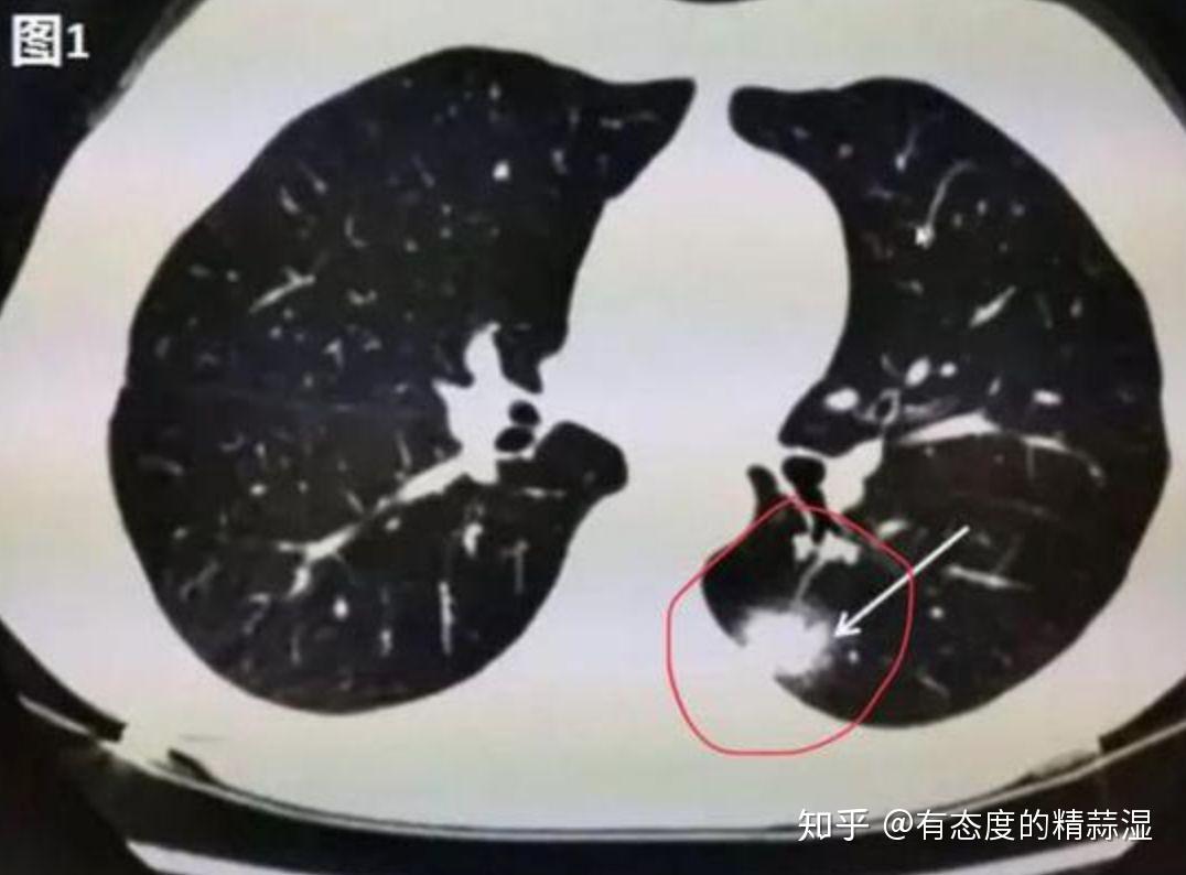肺ct图片怎么看图解,正常肺部ct高清图 - 伤感说说吧