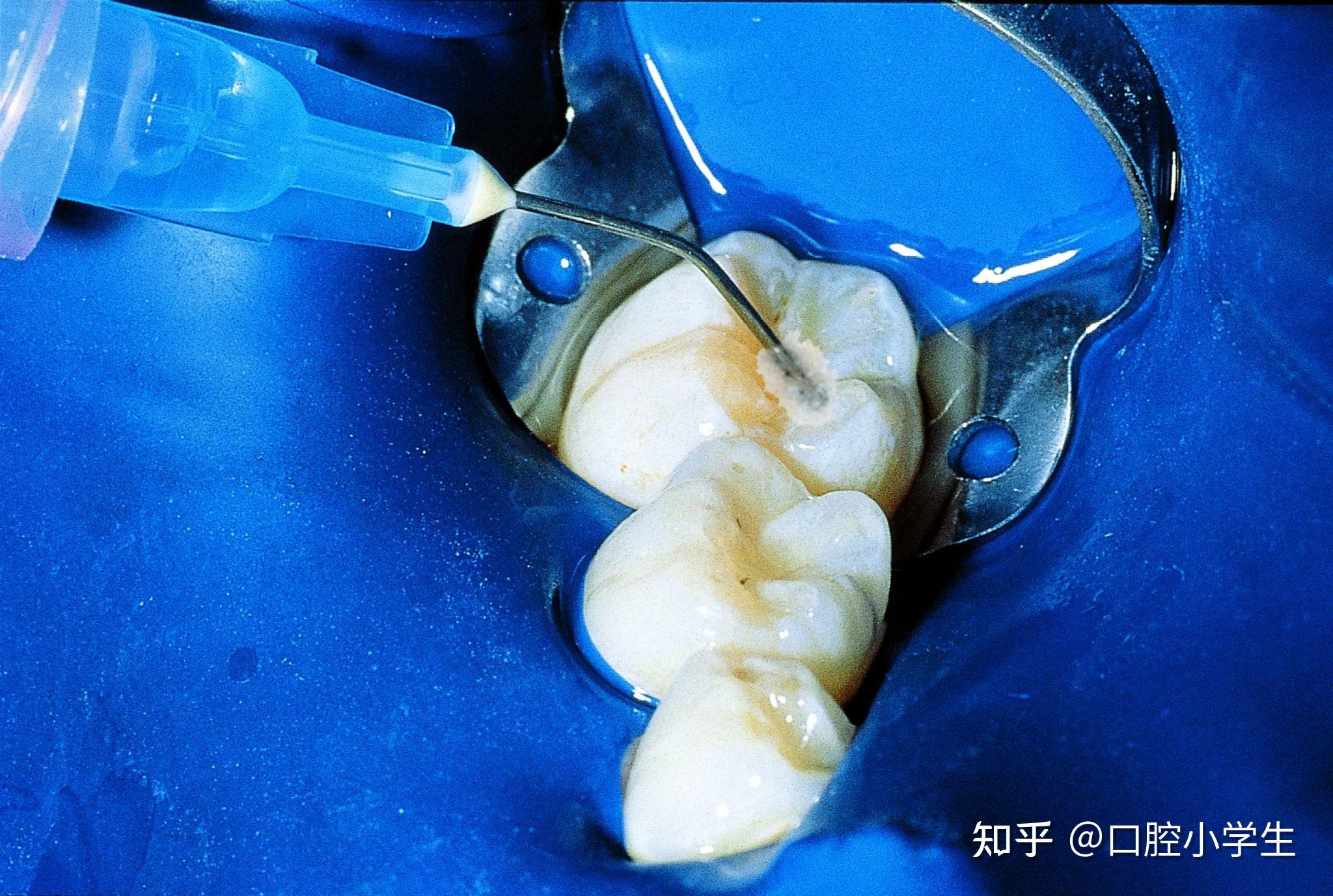 注意保护好儿童的“六龄齿”—窝沟封闭-健康教育-清华大学附属北京清华长庚医院口腔科