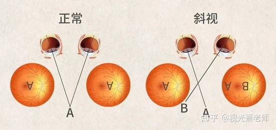 歪头看？对对眼？这是斜视吗？成都普瑞斜视专家杨英教你如何判断孩子斜视！ - 知乎
