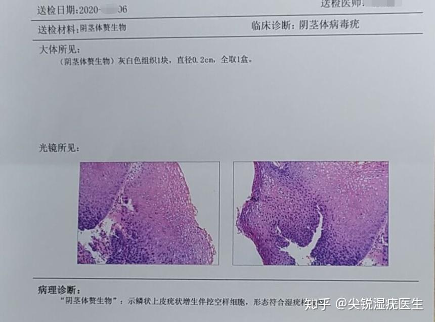 初期小疣体图片真实_疣的初期照片_疣体早期