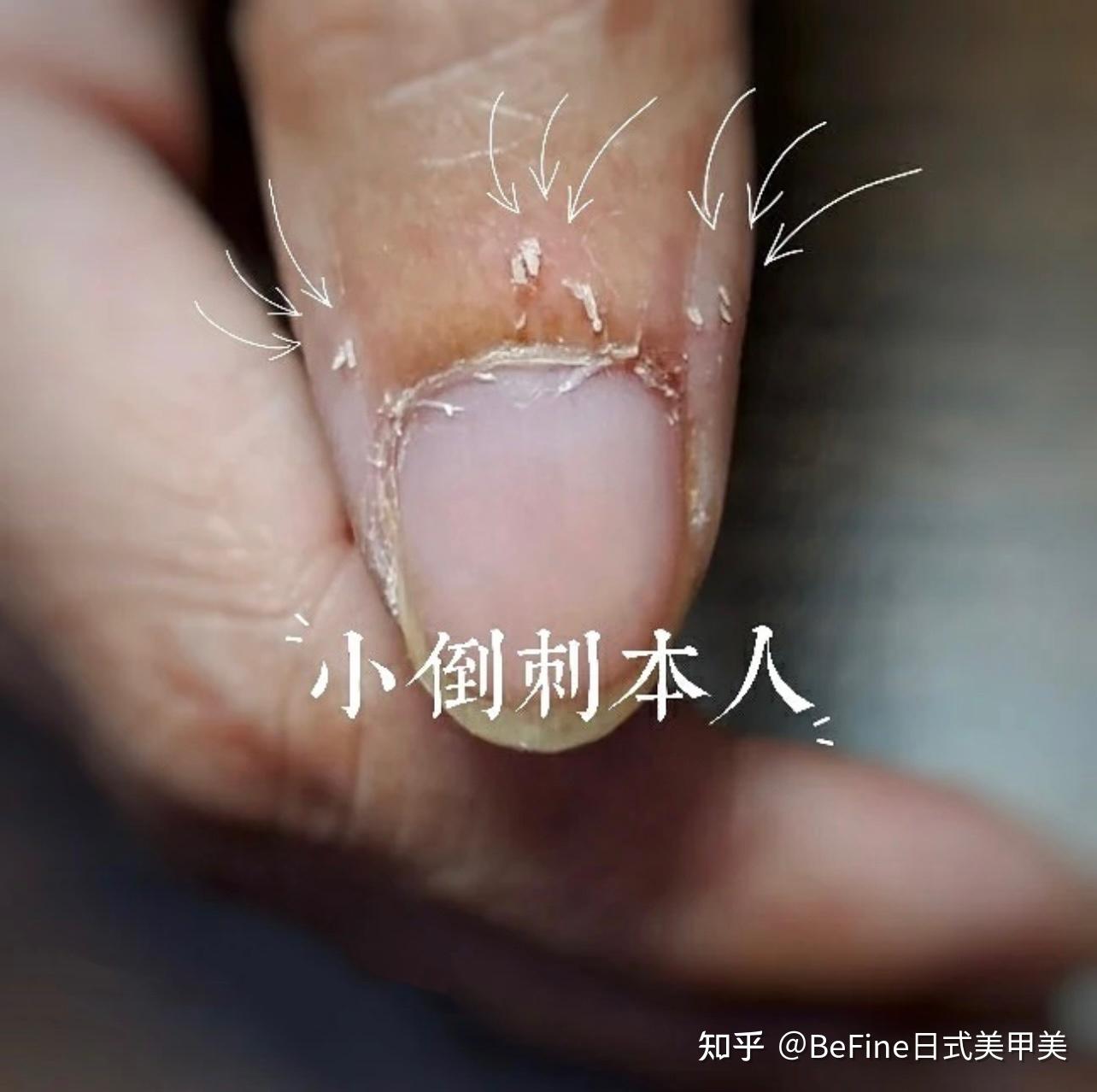 这是你的手指吗?倒刺死皮让我们来一起KO它 - 知乎