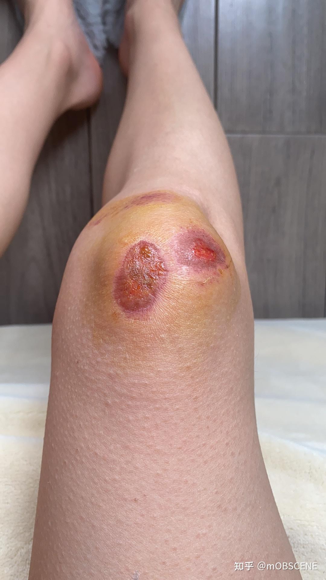 记录膝盖擦伤 - 知乎