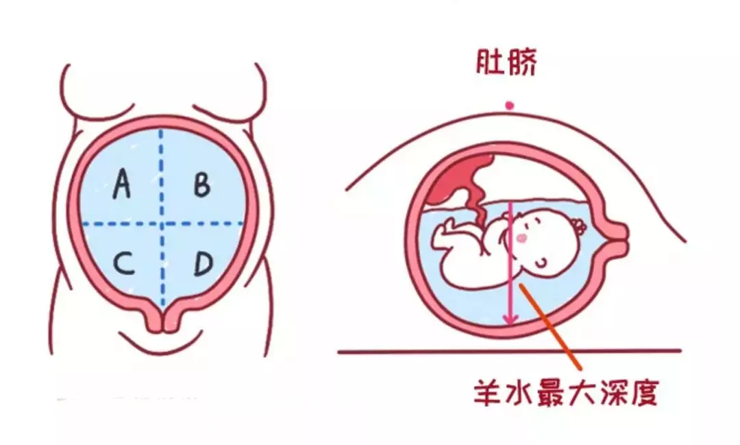 羊水少居然有这么多危害