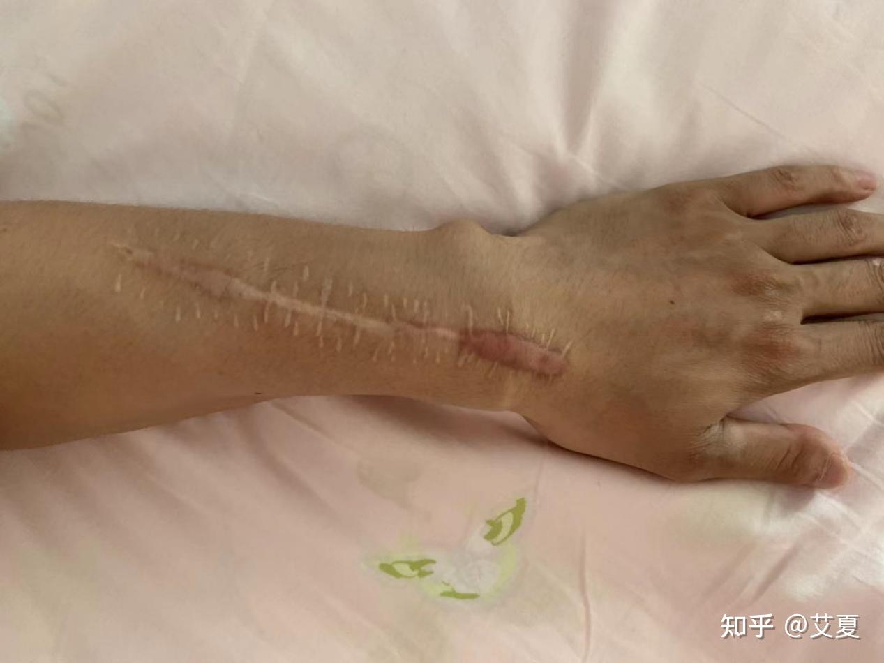 关于马德隆畸形(做过手术)