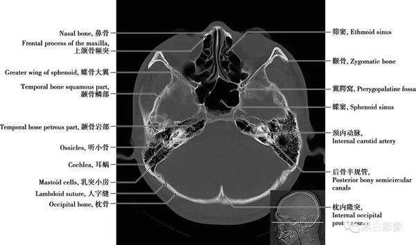详细标注版!颅脑CT正常解剖图谱 - 知乎