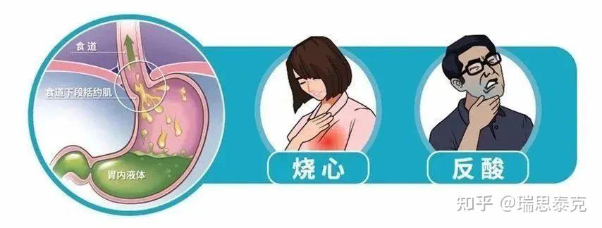 胃食管反流病检查中的反流监测都有哪些？ - 知乎