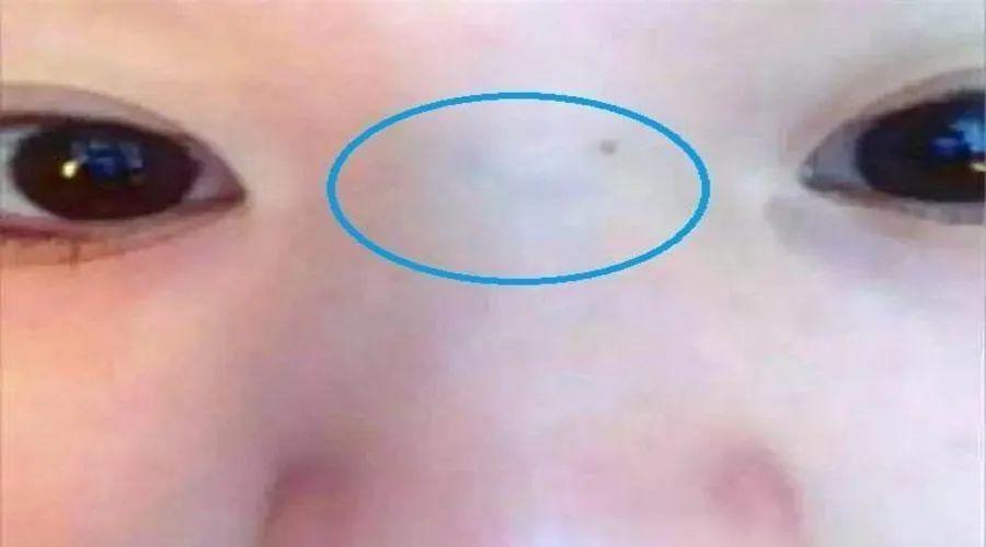 鼻梁青筋舌下青筋腿部青筋的预意和艾灸法