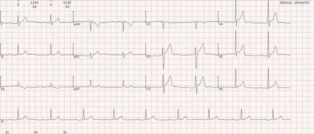 心电图图谱 2如图所示,p波在Ⅰ,Ⅱ,avf,v4