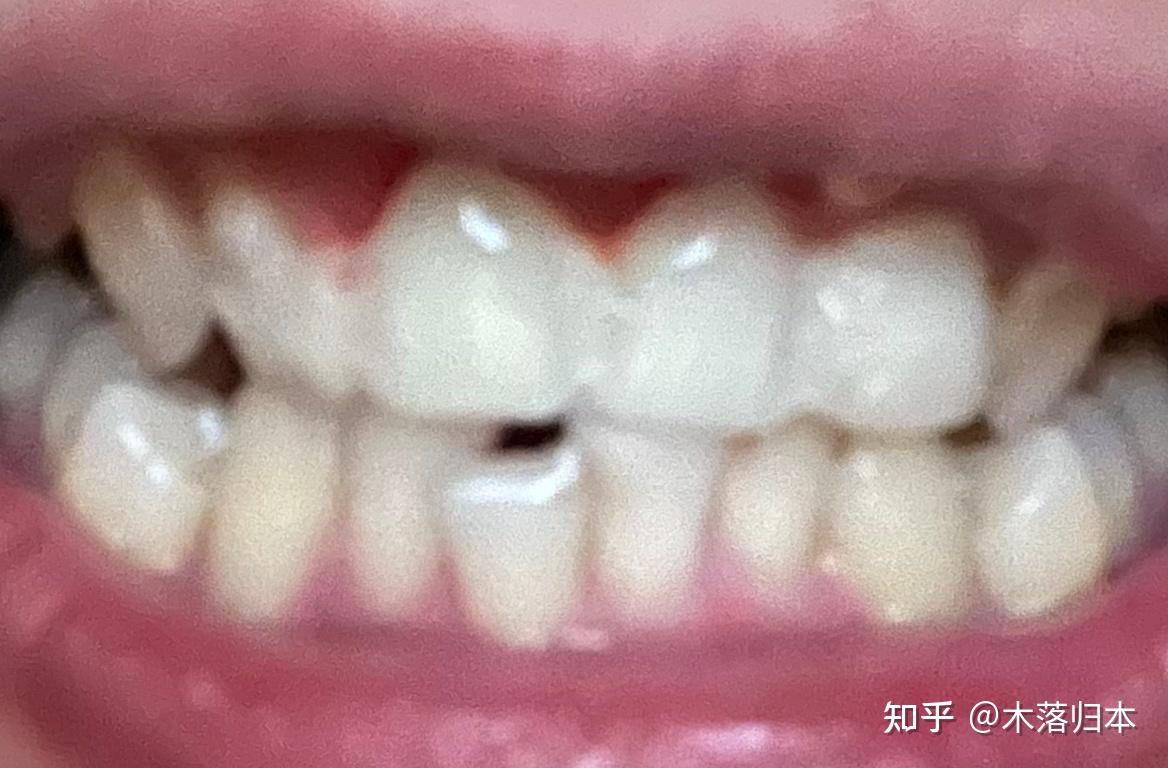 广州种植牙｜广州种牙｜种植牙一期二期三期过程 - 知乎
