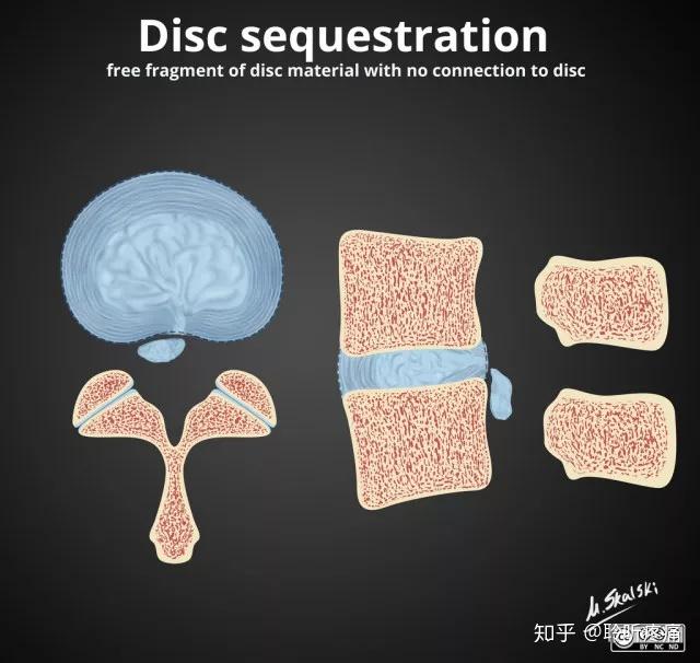 椎间盘突出、膨出、脱出如何鉴别，几幅图让你一目了然 知乎
