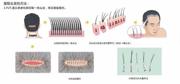 植发要多少钱一般（自己怎么预估植发价格）