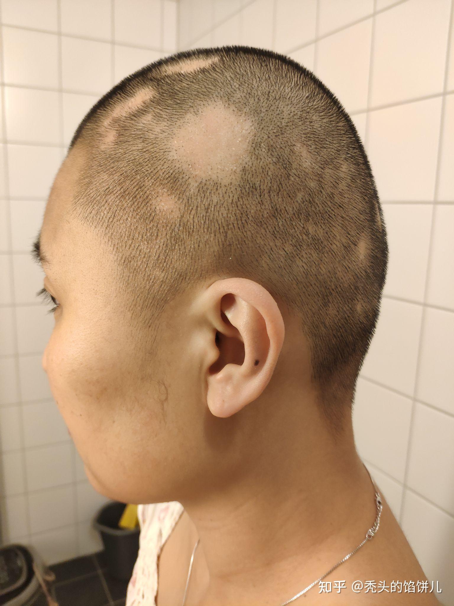 不定时更新4,斑秃复发中…2年斑秃全秃患者