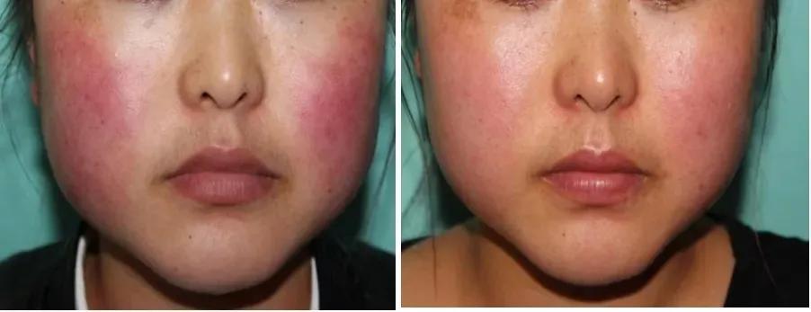 主要治疗:鲜红斑痣,红血丝,蜘蛛痣,酒糟鼻,疤痕等.