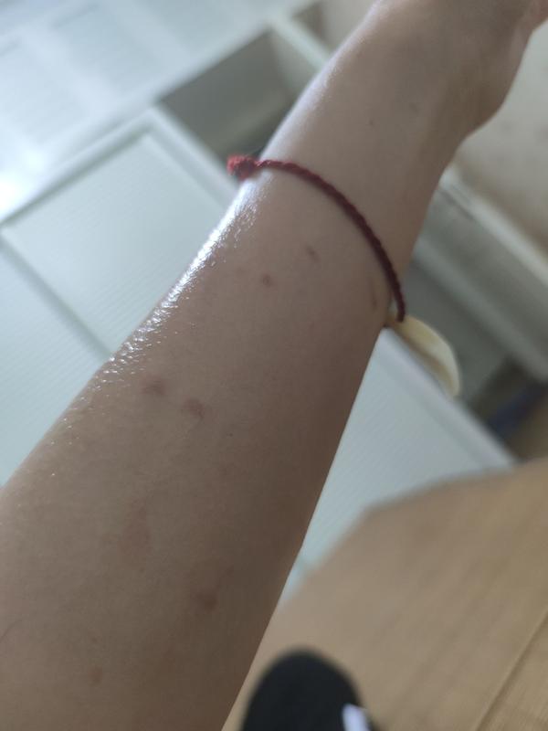 被油烫伤后会留疤和印记吗 知乎