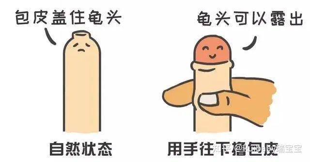 包皮过长▼包茎▼听到"包皮"这个词儿,很多人的第一反应就是包皮过长