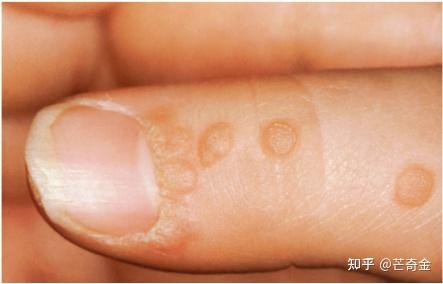 进入青春期以后,青少年皮肤红润,细腻有光泽;角质形成细胞增生活跃