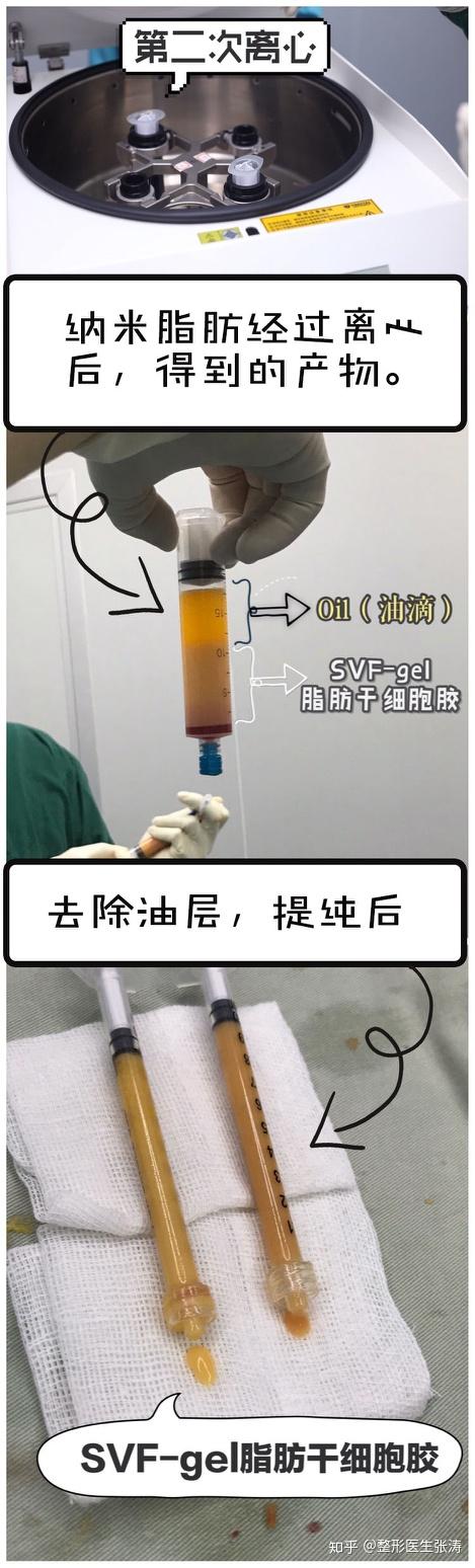 脂肪移植黑科技——SVF-gel脂肪干细胞胶 - 知乎