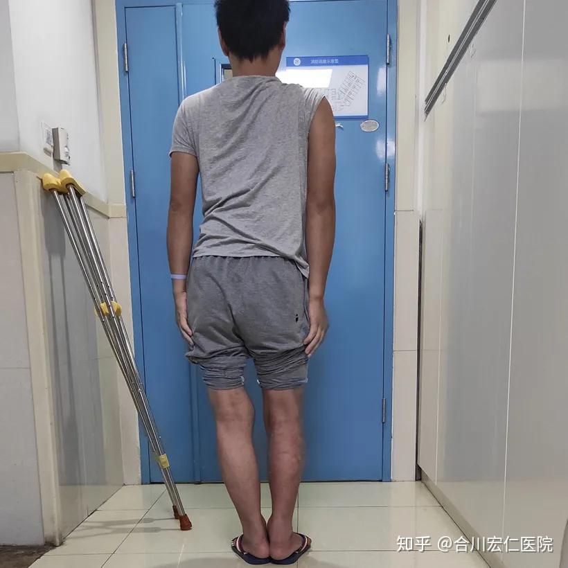 双下肢畸形30年没想到还能正常行走