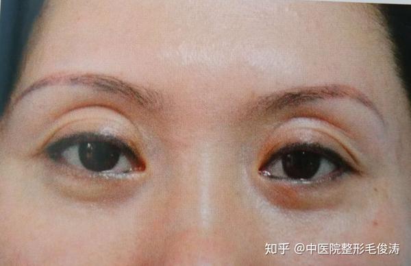 双眼皮三重睑如何修复 知乎