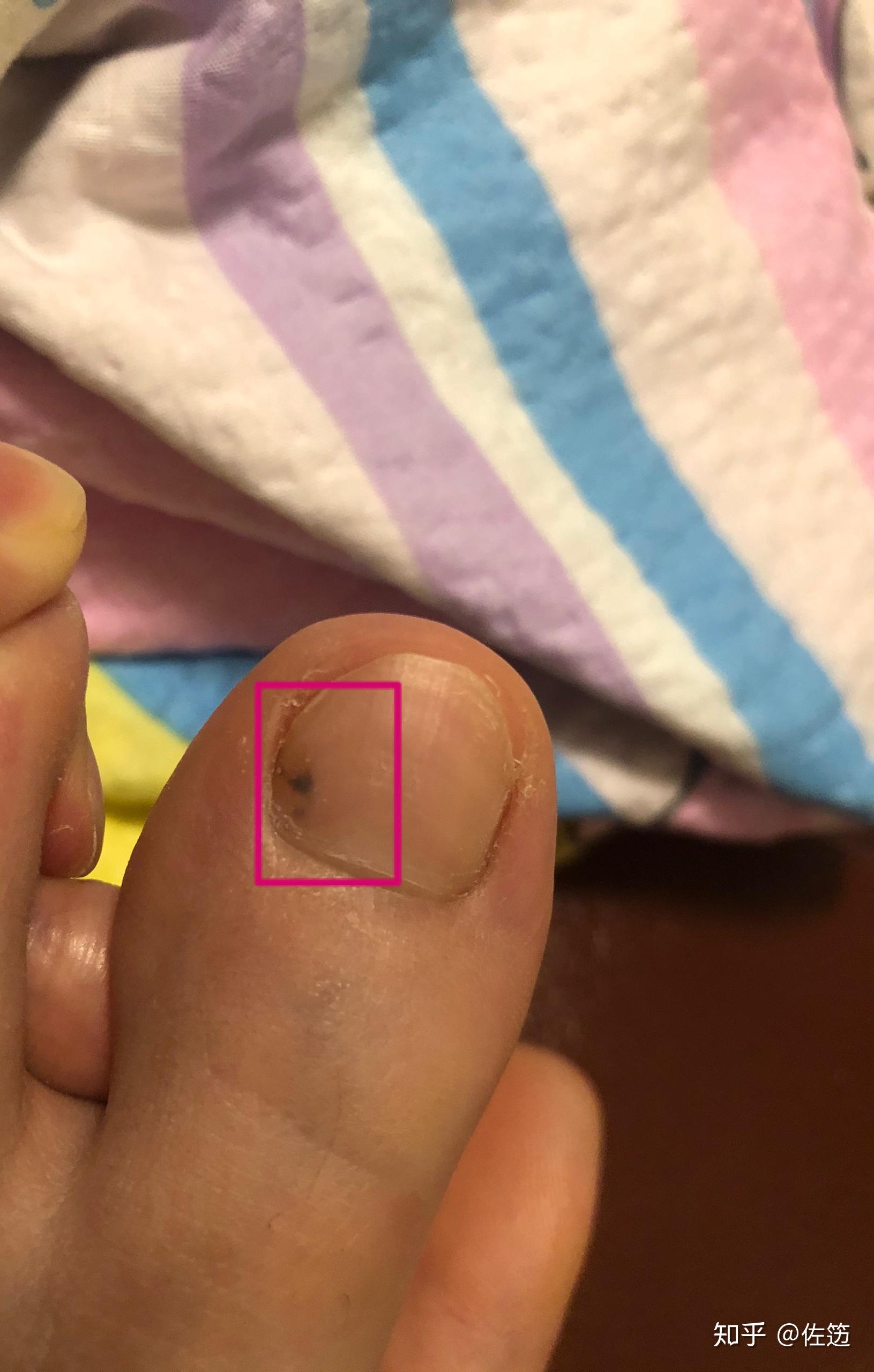 大脚趾头黑色素瘤图片图片