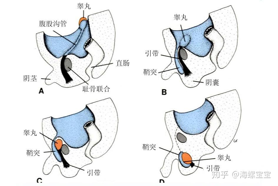 巨睾症真实图片