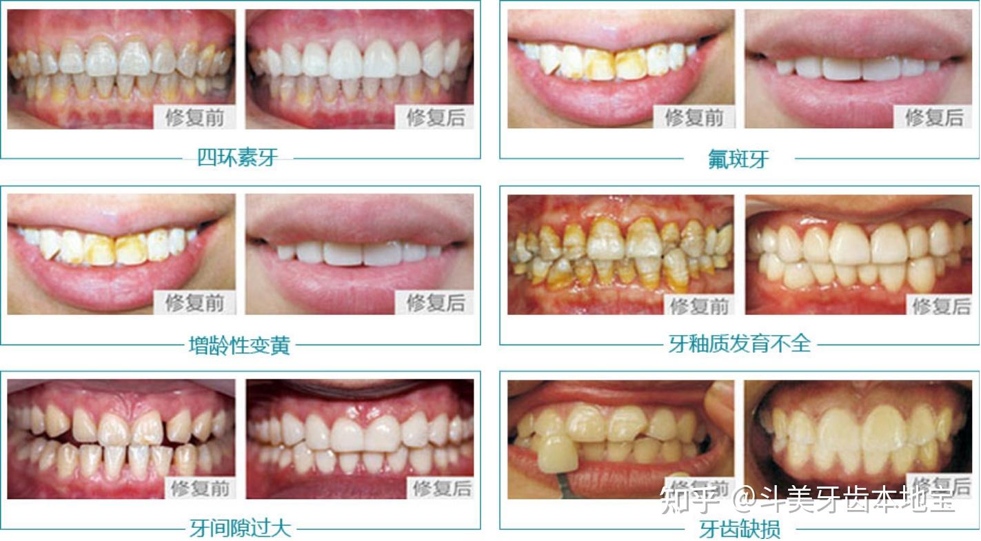 而且贴面能够解决的问题也是比较多的