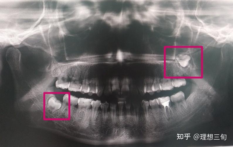 智齒長進上頜竇要拔還是不拔該怎麼辦