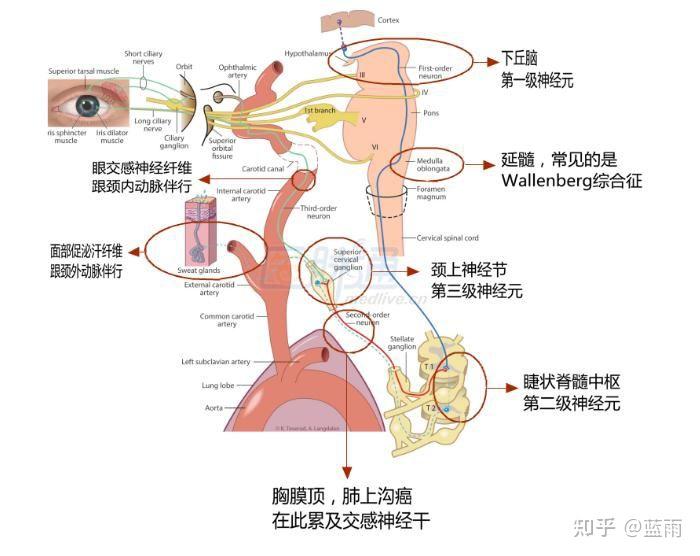 溫覺缺失(三叉神經脊髓核損害),對側偏身痛,溫覺減退或喪失(脊髓丘腦