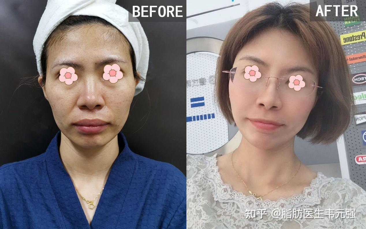 眼袋明显、法令纹、脸颊凹陷,想要实现面部年轻化,怎么就这么难? - 知乎