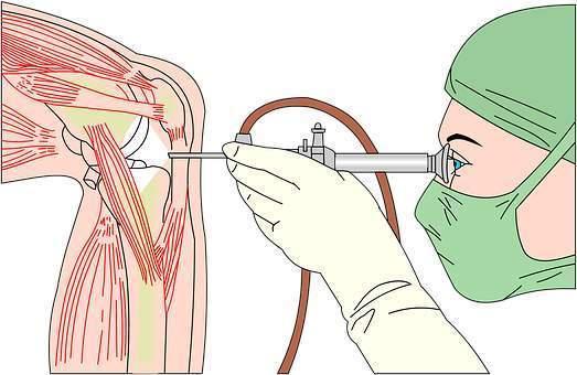 骨关节炎怎么治疗 关节腔注射还是手术置换 知乎